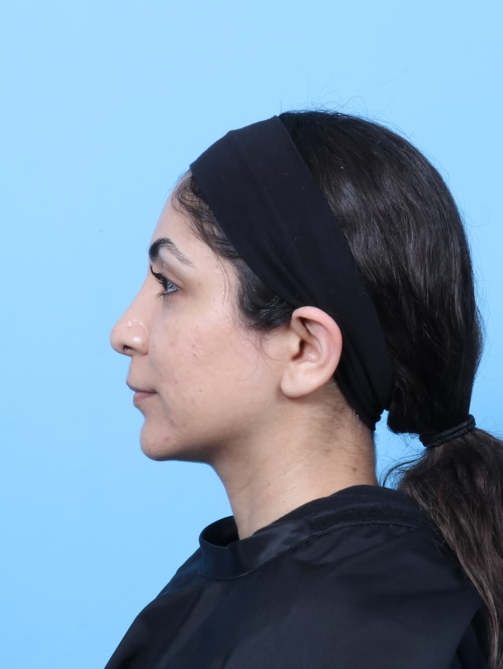 Rhinoplasty case #8776 after, image 1