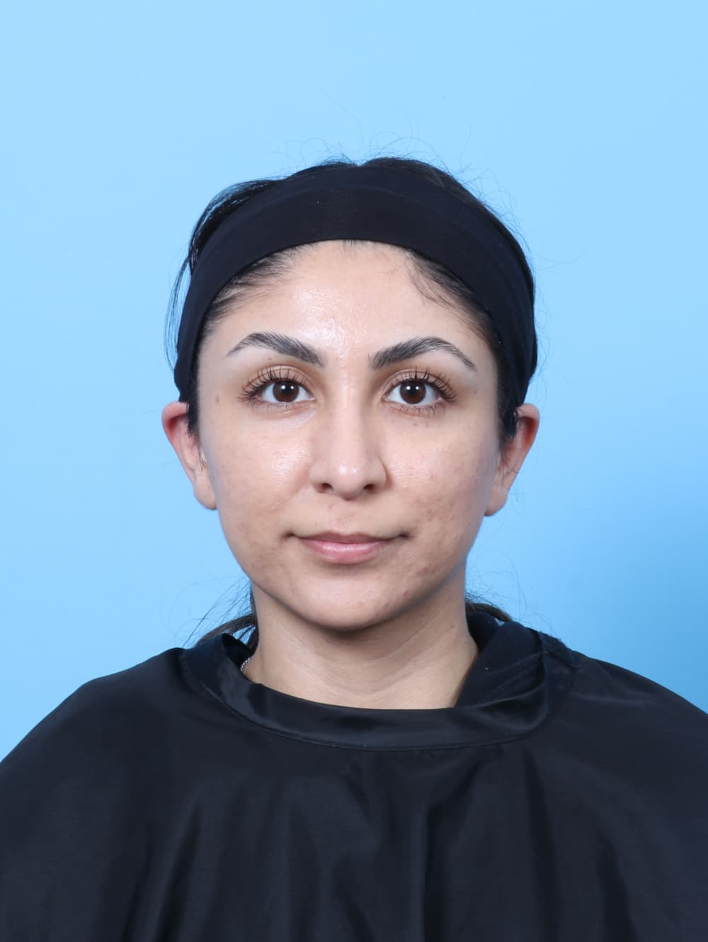 Rhinoplasty case #8776 after, image 2