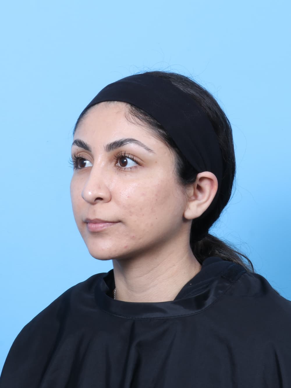 Rhinoplasty case #8776 after, image 3