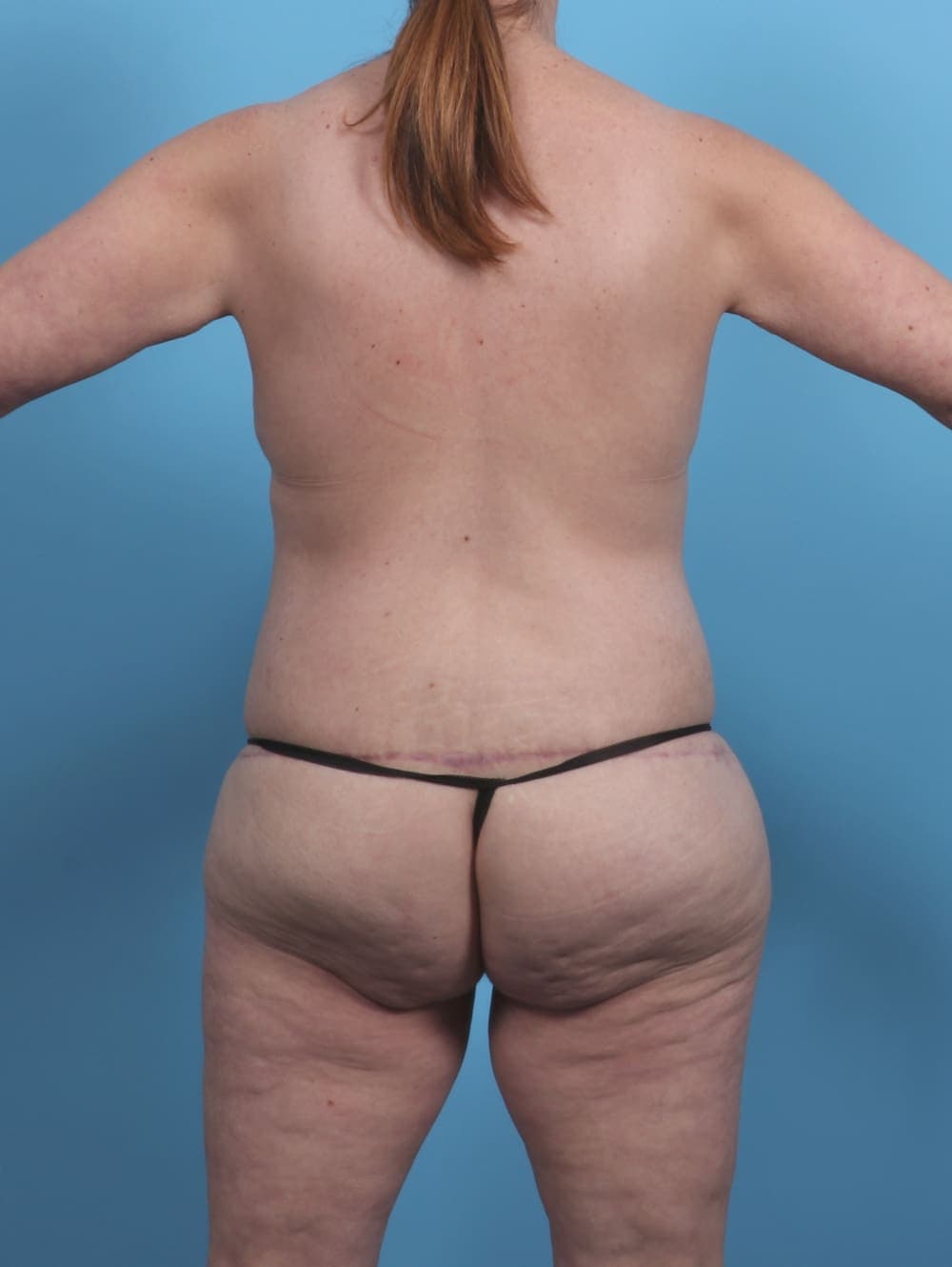 Body Lift case #4523 after, image 2