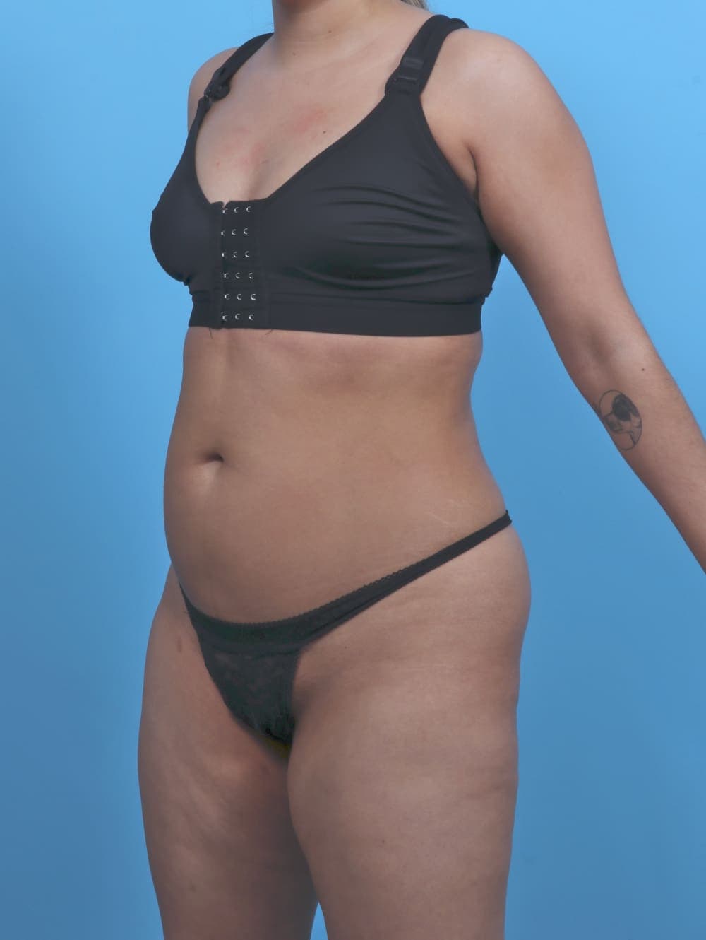 Liposuction case #5976 before, image 2