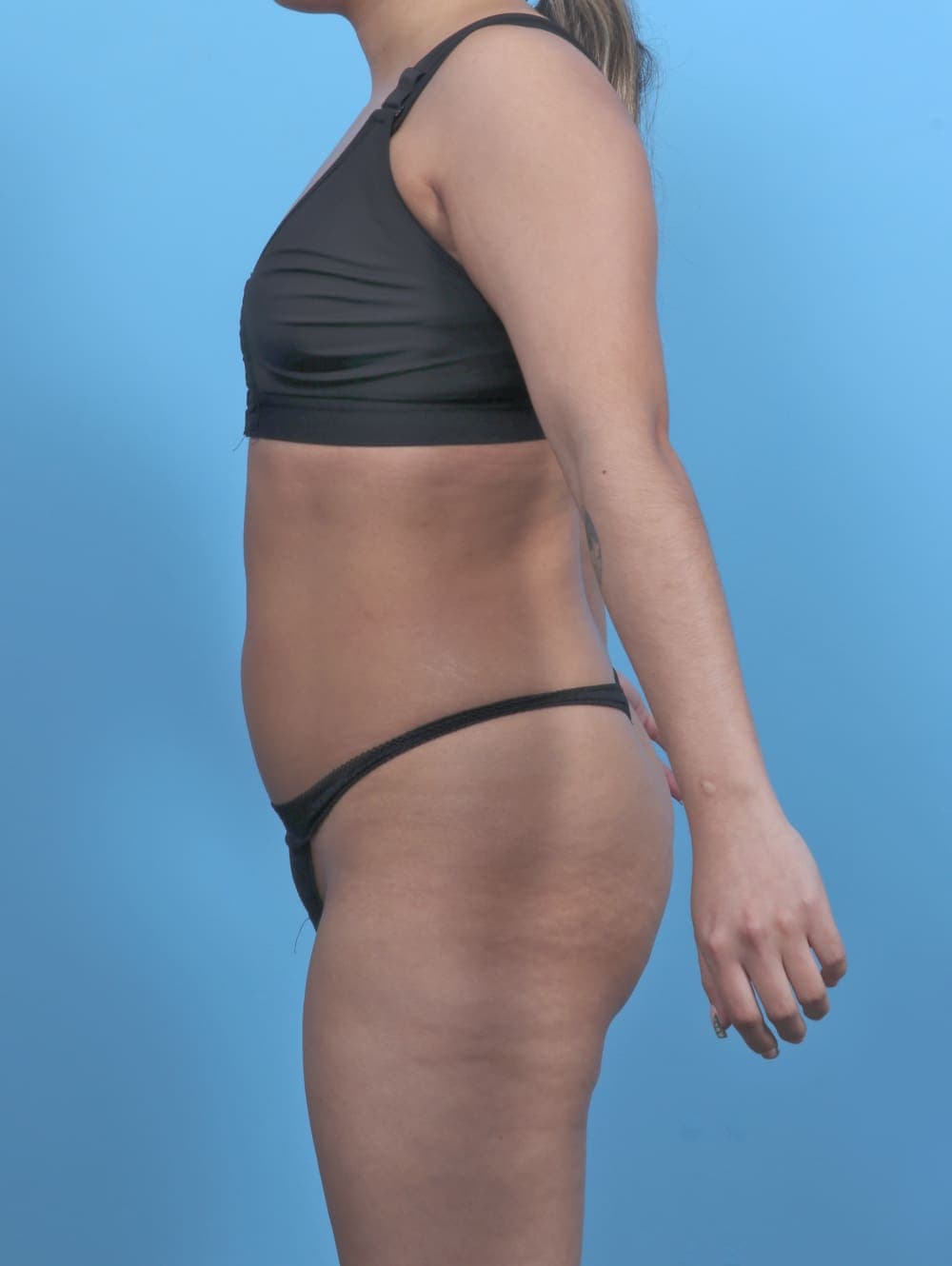 Liposuction case #5976 before, image 3