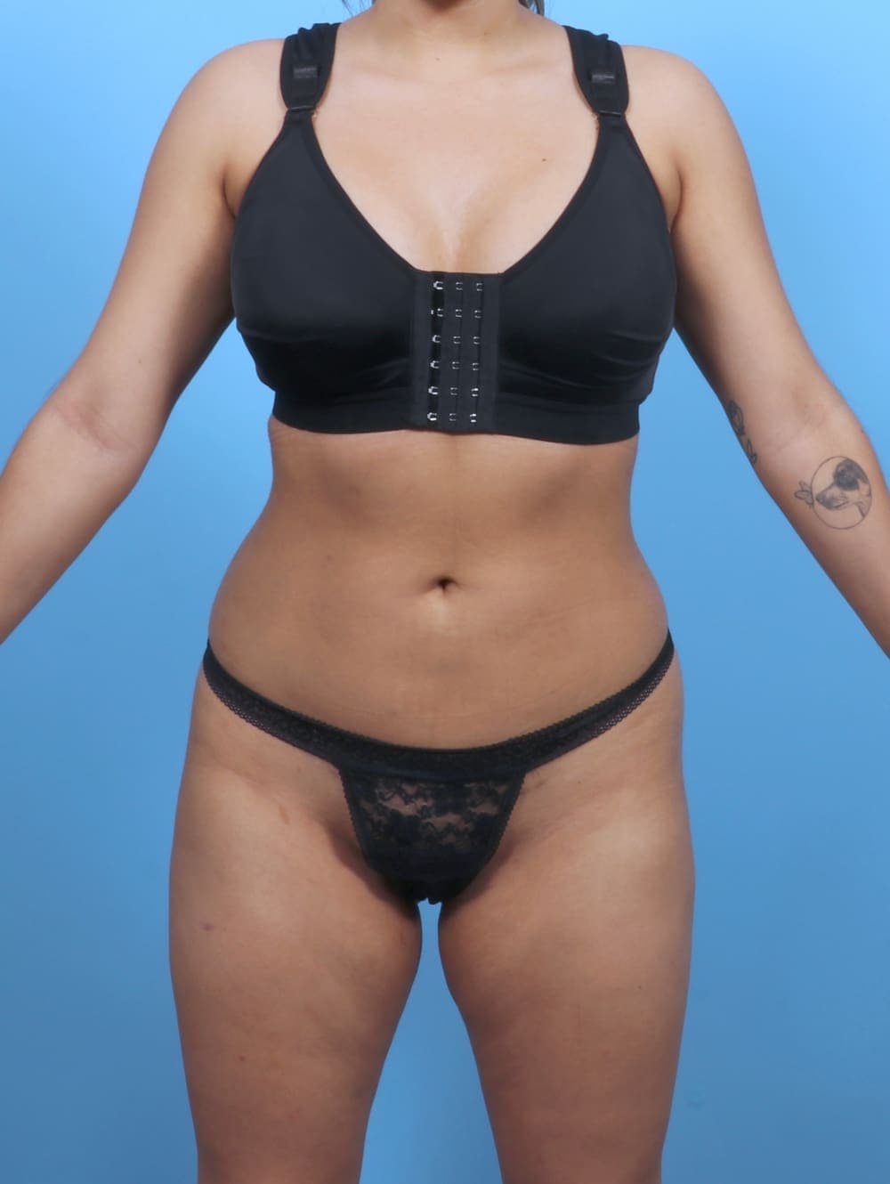 Liposuction case #5976 after, image 1