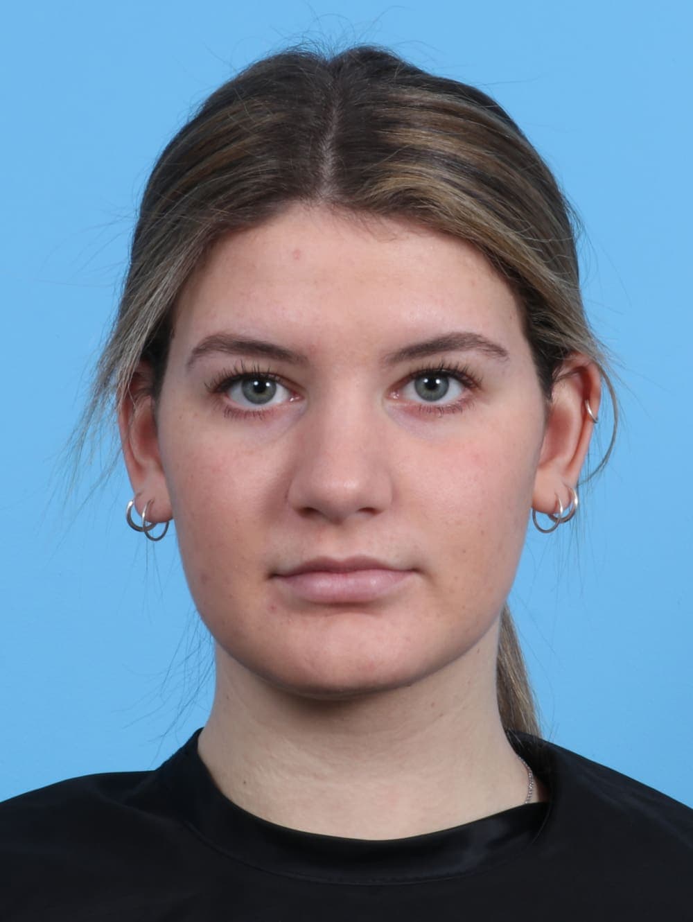 Rhinoplasty case #3145 after, image 2