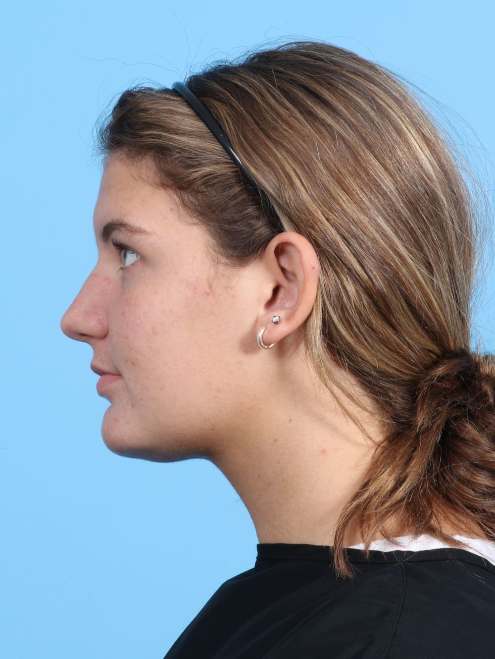 Rhinoplasty case #3145 before