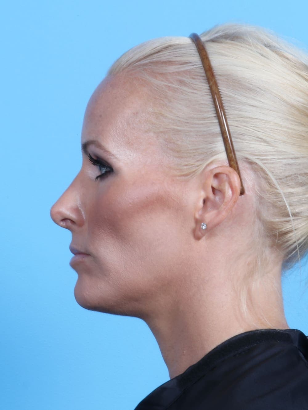 Rhinoplasty case #2655 after, image 1