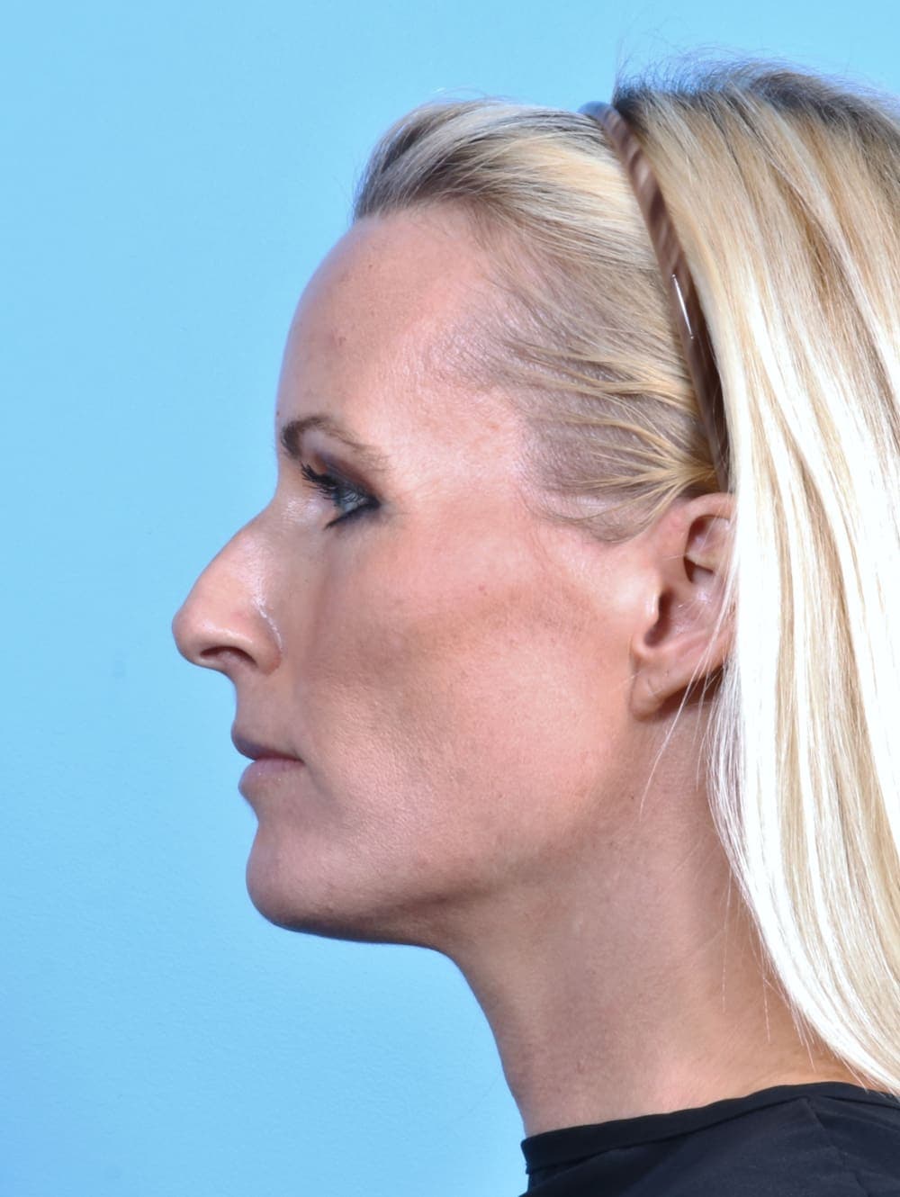 Rhinoplasty case #2655 before, image 1