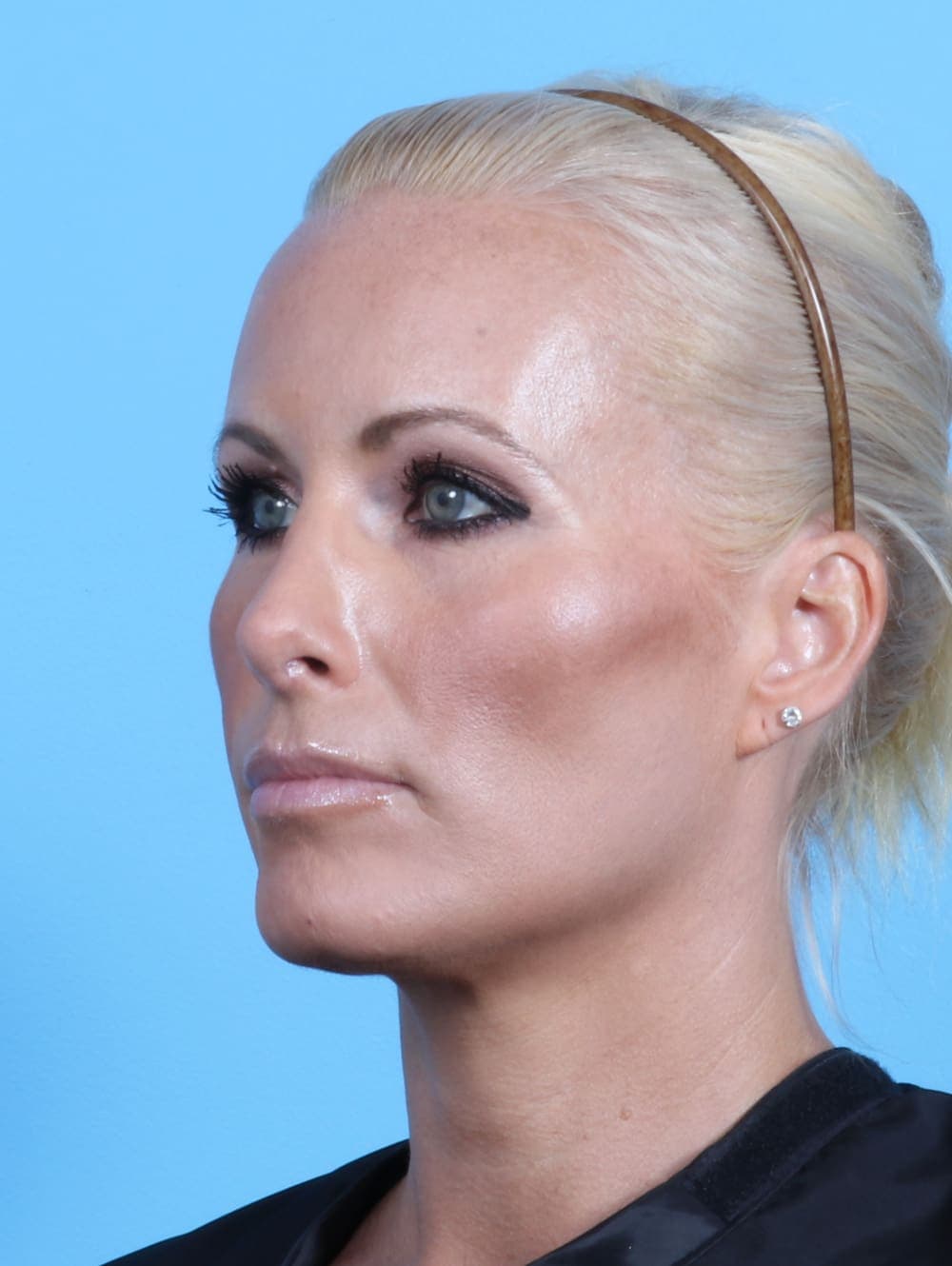 Rhinoplasty case #2655 after, image 3