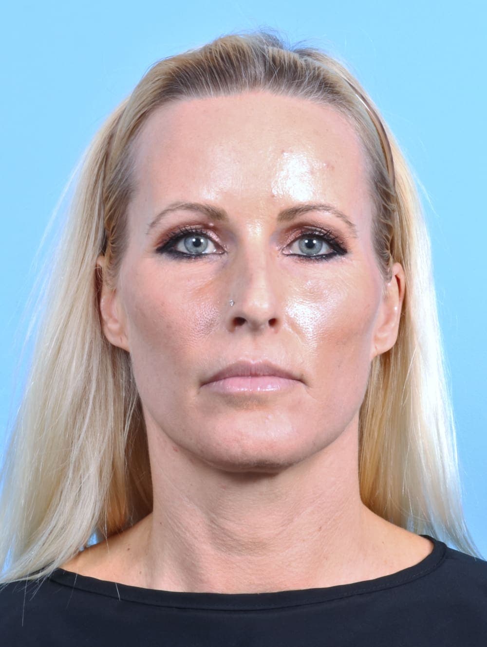 Rhinoplasty case #2655 before, image 2