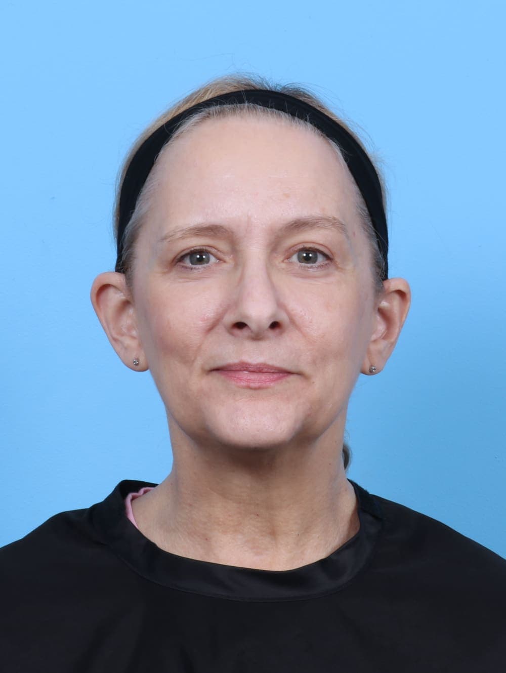Eyelid Surgery case #5797 after, image 1