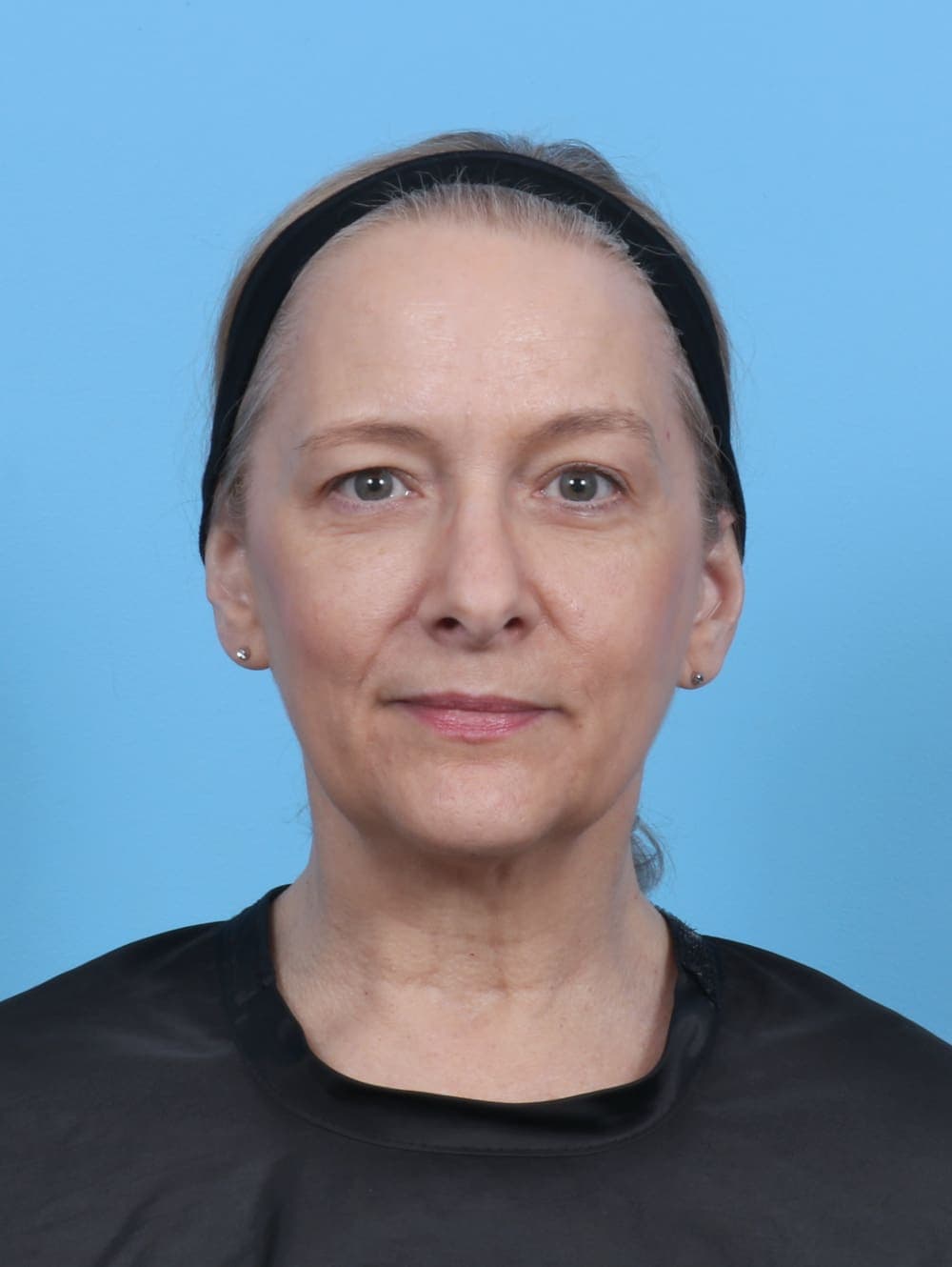 Eyelid Surgery case #5797 before, image 1