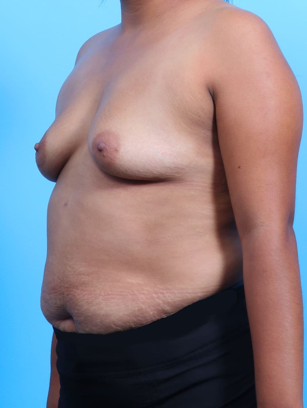 Breast Augmentation case #3112 before, image 2
