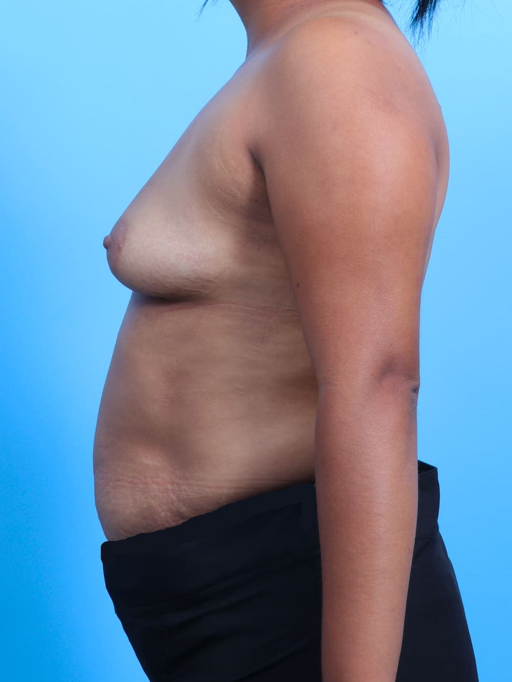 Breast Augmentation case #3112 before, image 3