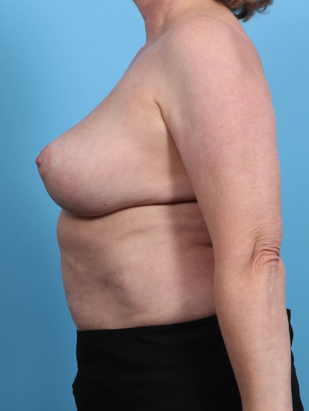 Breast Lift/Reduction case #3594 after, image 3