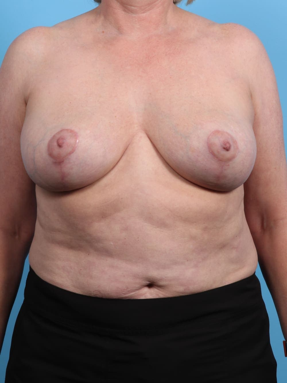 Breast Lift/Reduction case #3594 after, image 1