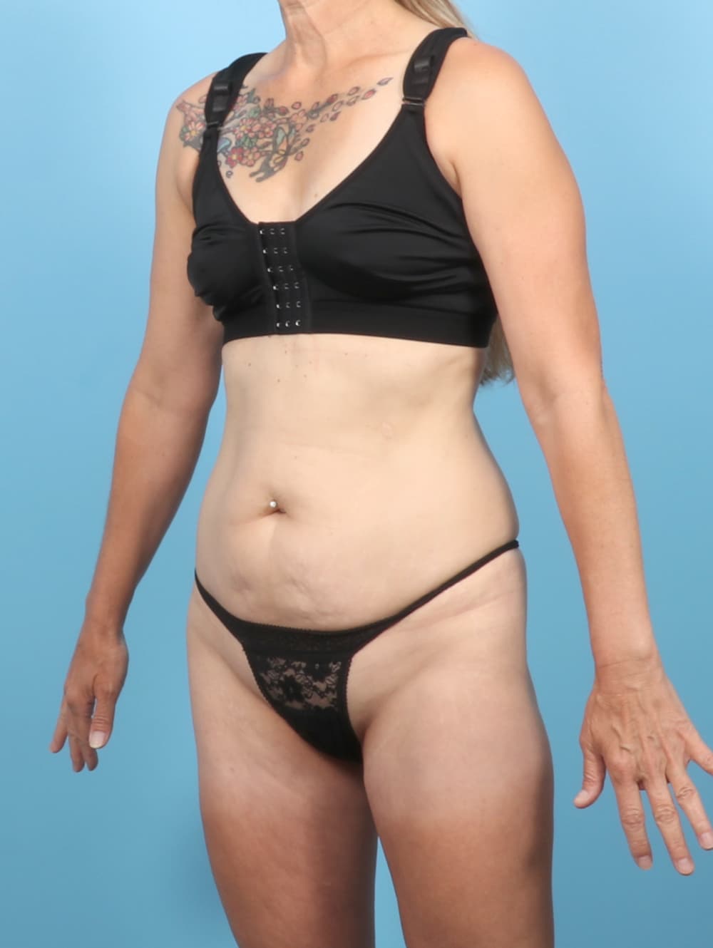 Tummy Tuck case #8370 before, image 2