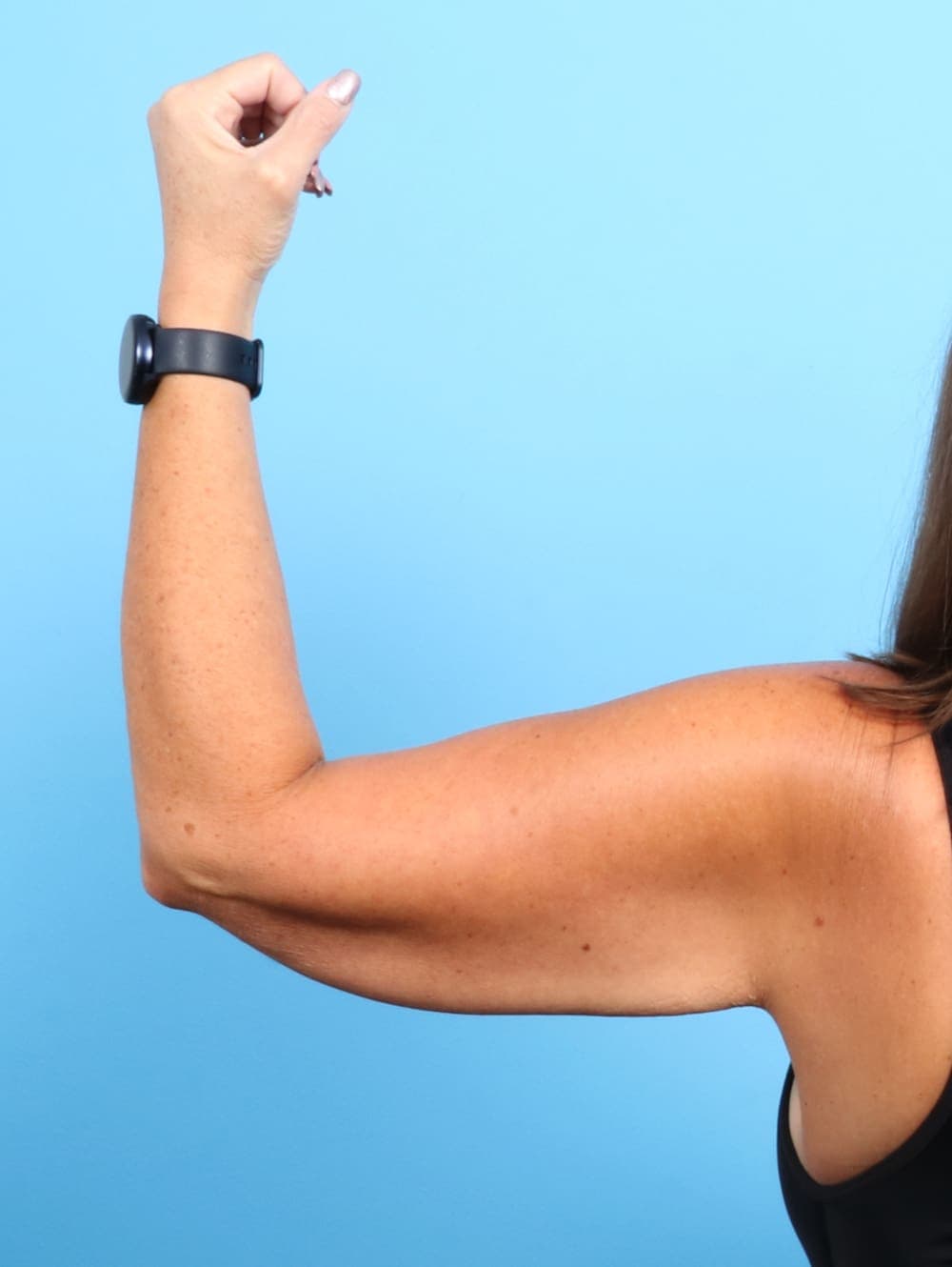 Arm Lift case #2468 before, image 1