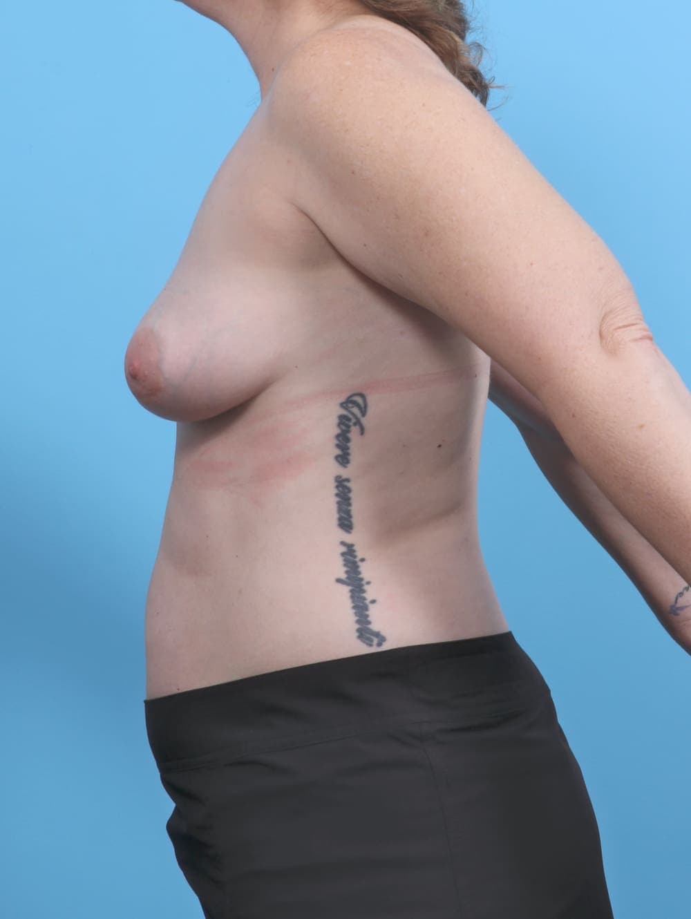Breast Implant Revision case #5773 before, image 3