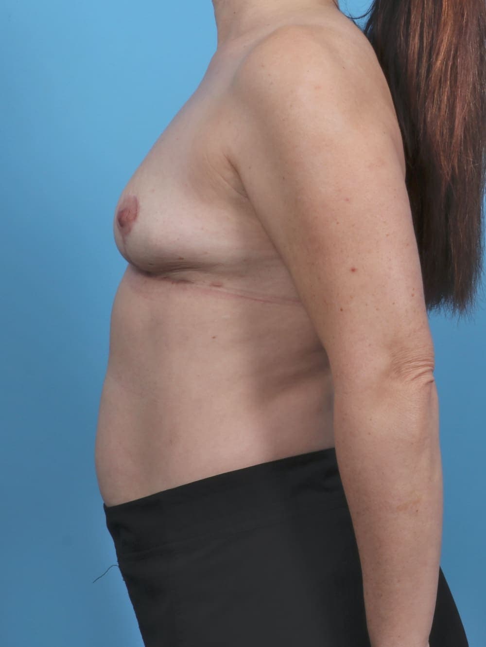 Breast Lift/Reduction case #5084 after, image 3