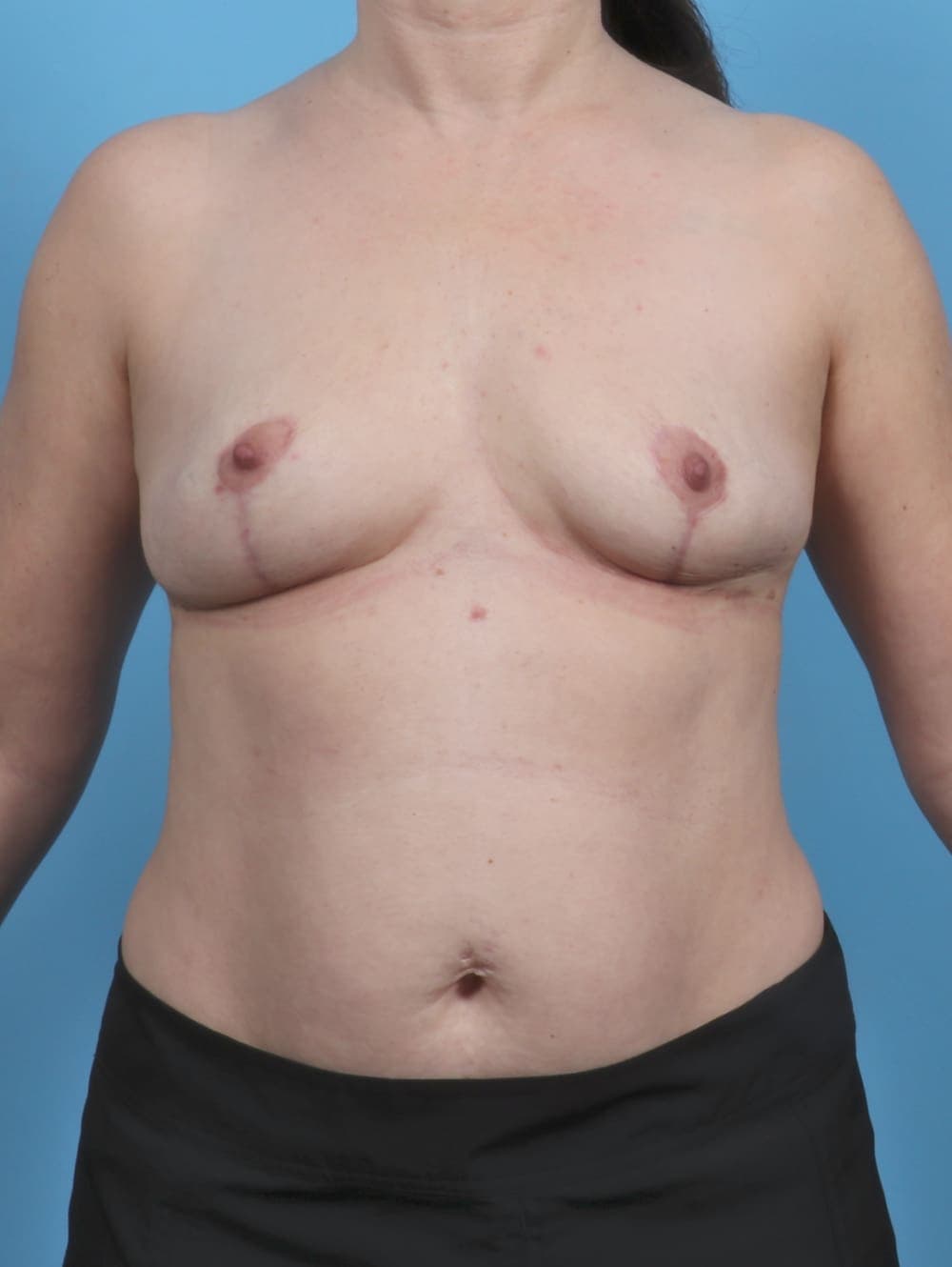 Breast Lift/Reduction case #5084 after, image 1