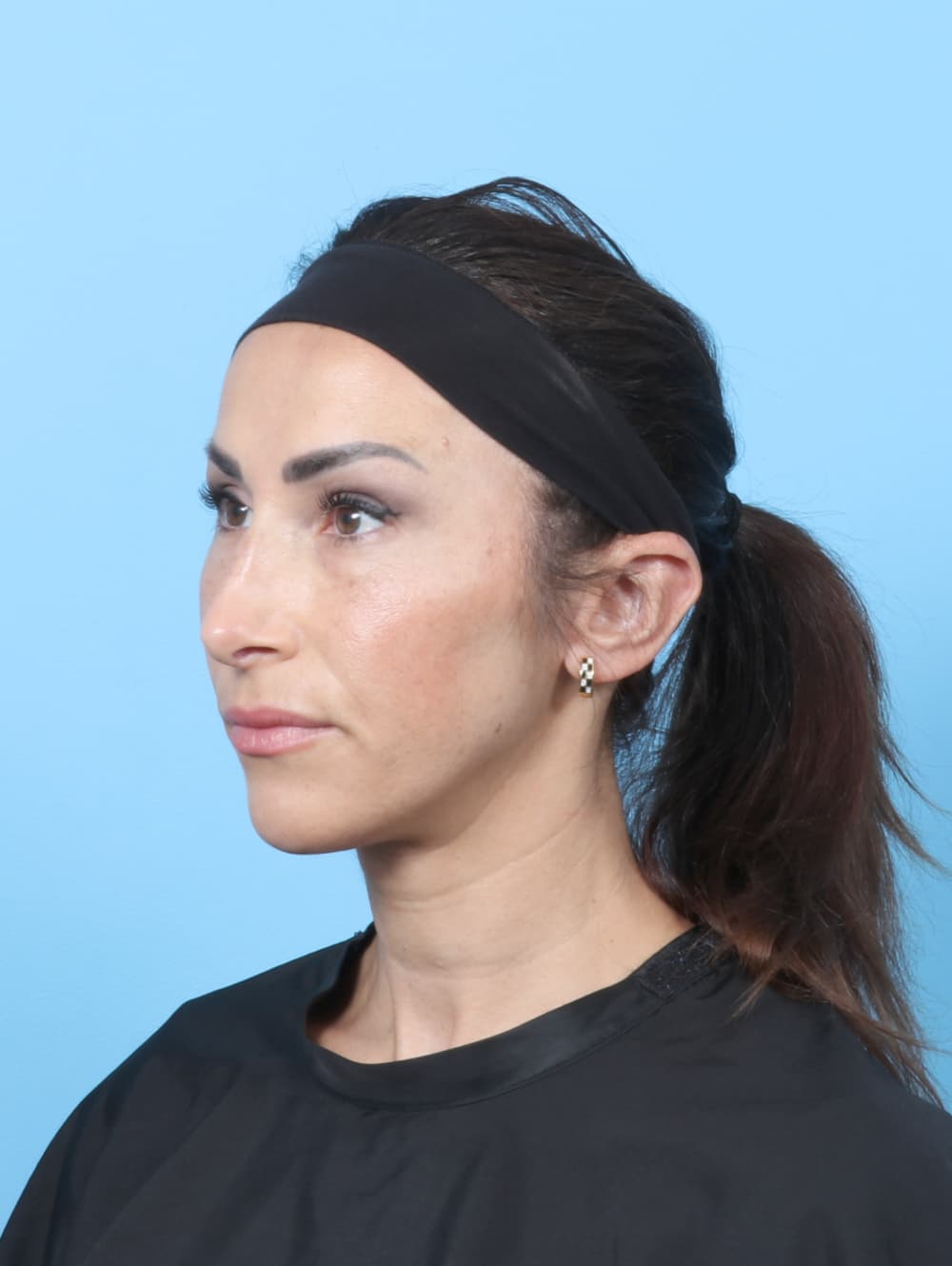Rhinoplasty case #8153 after, image 3