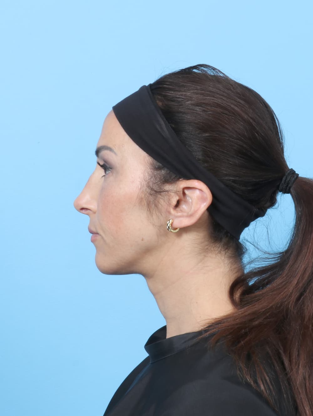 Rhinoplasty case #8153 after, image 1