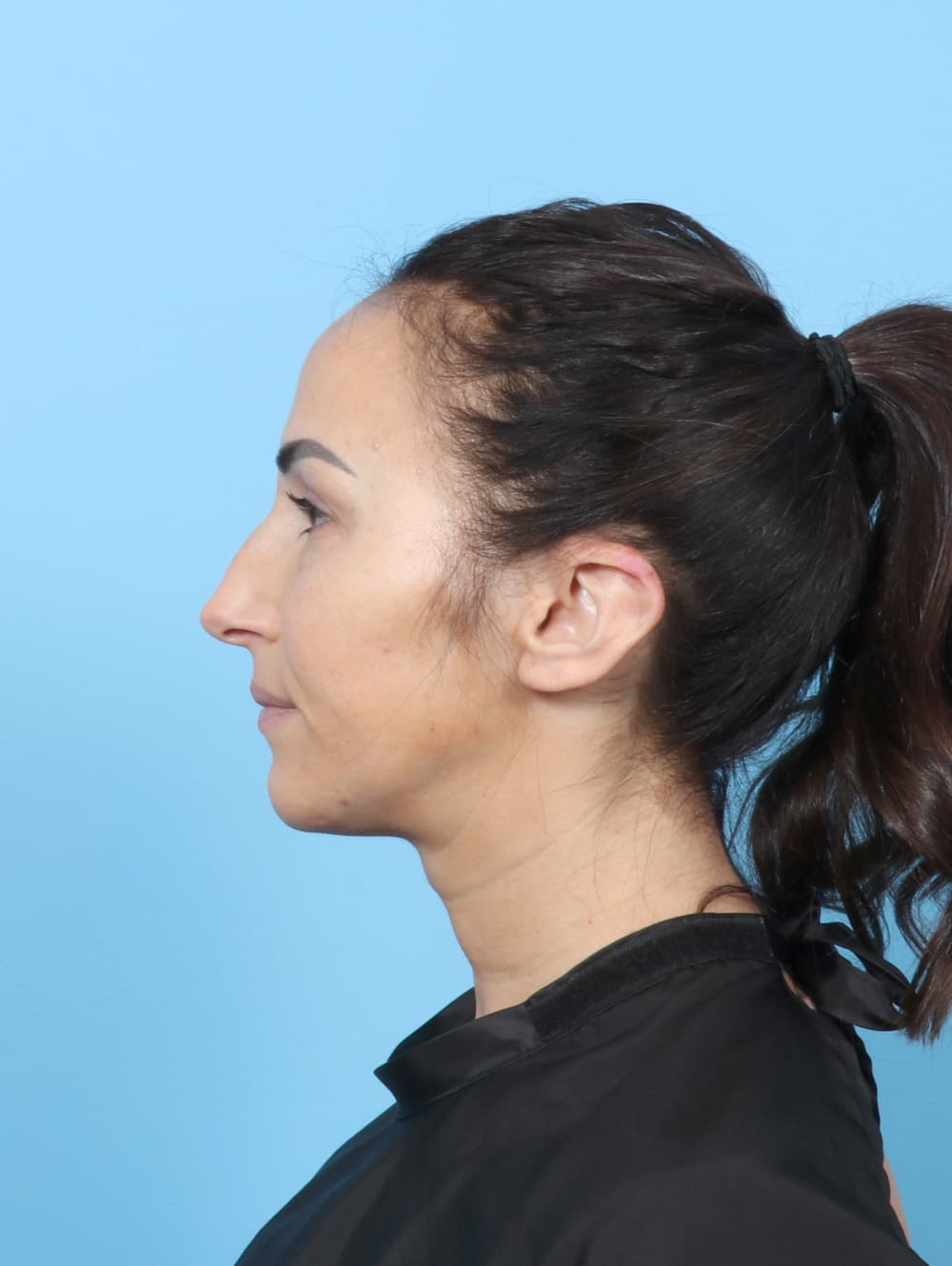 Rhinoplasty case #8153 before, image 1