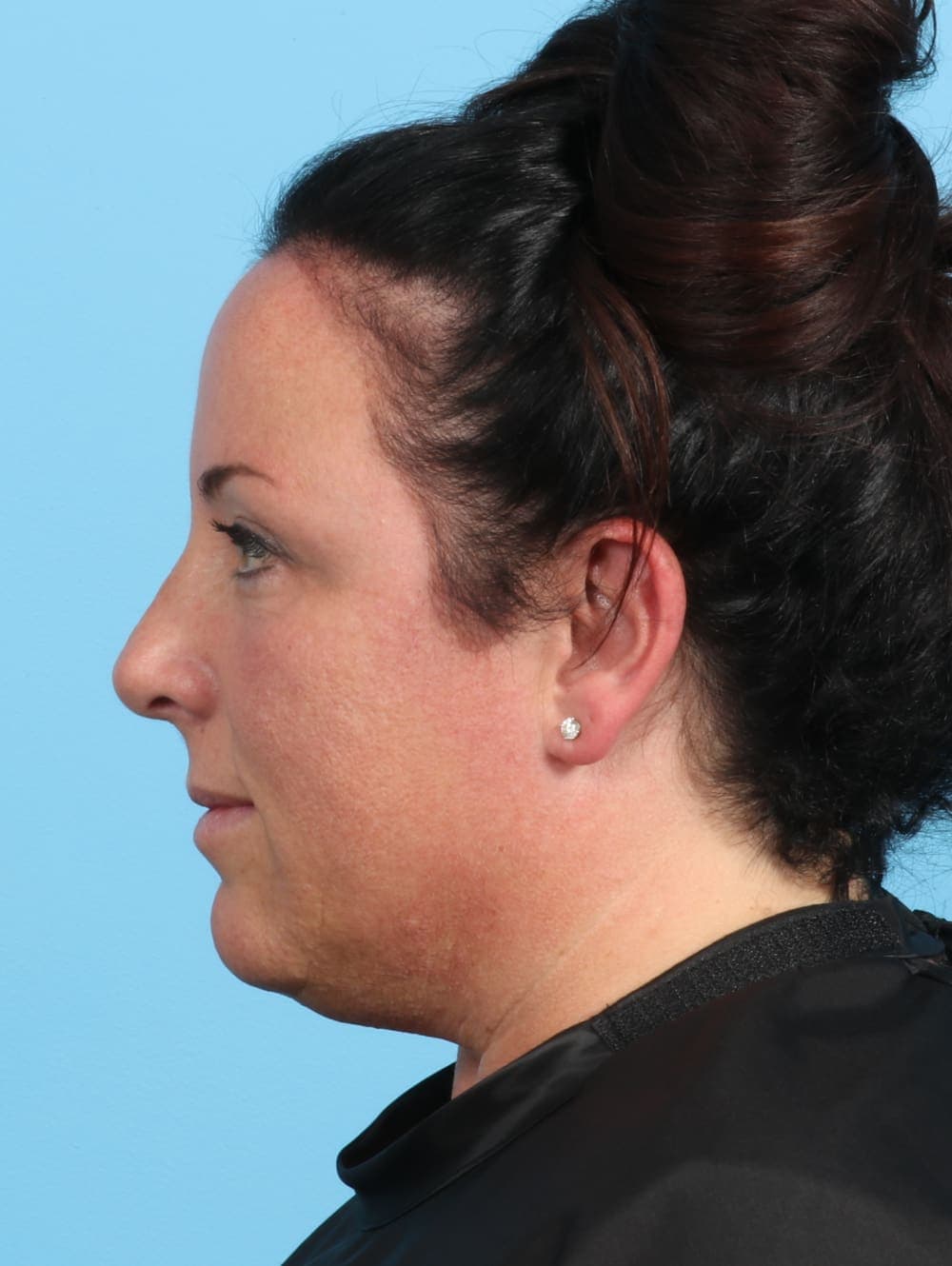 Rhinoplasty case #2671 after, image 1