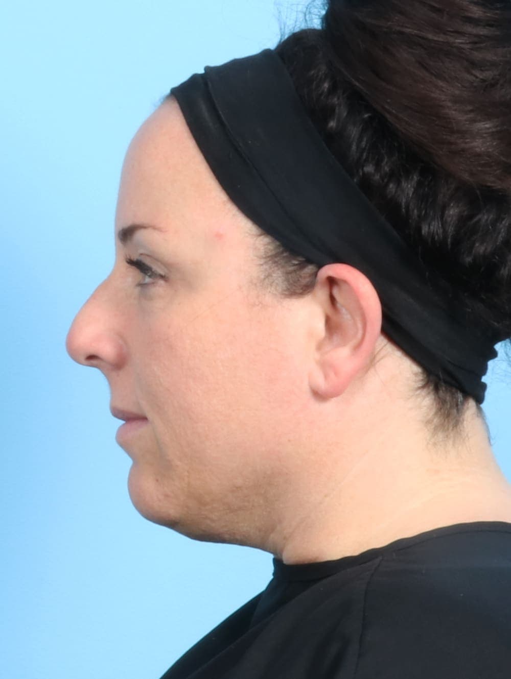 Rhinoplasty case #2671 before, image 1