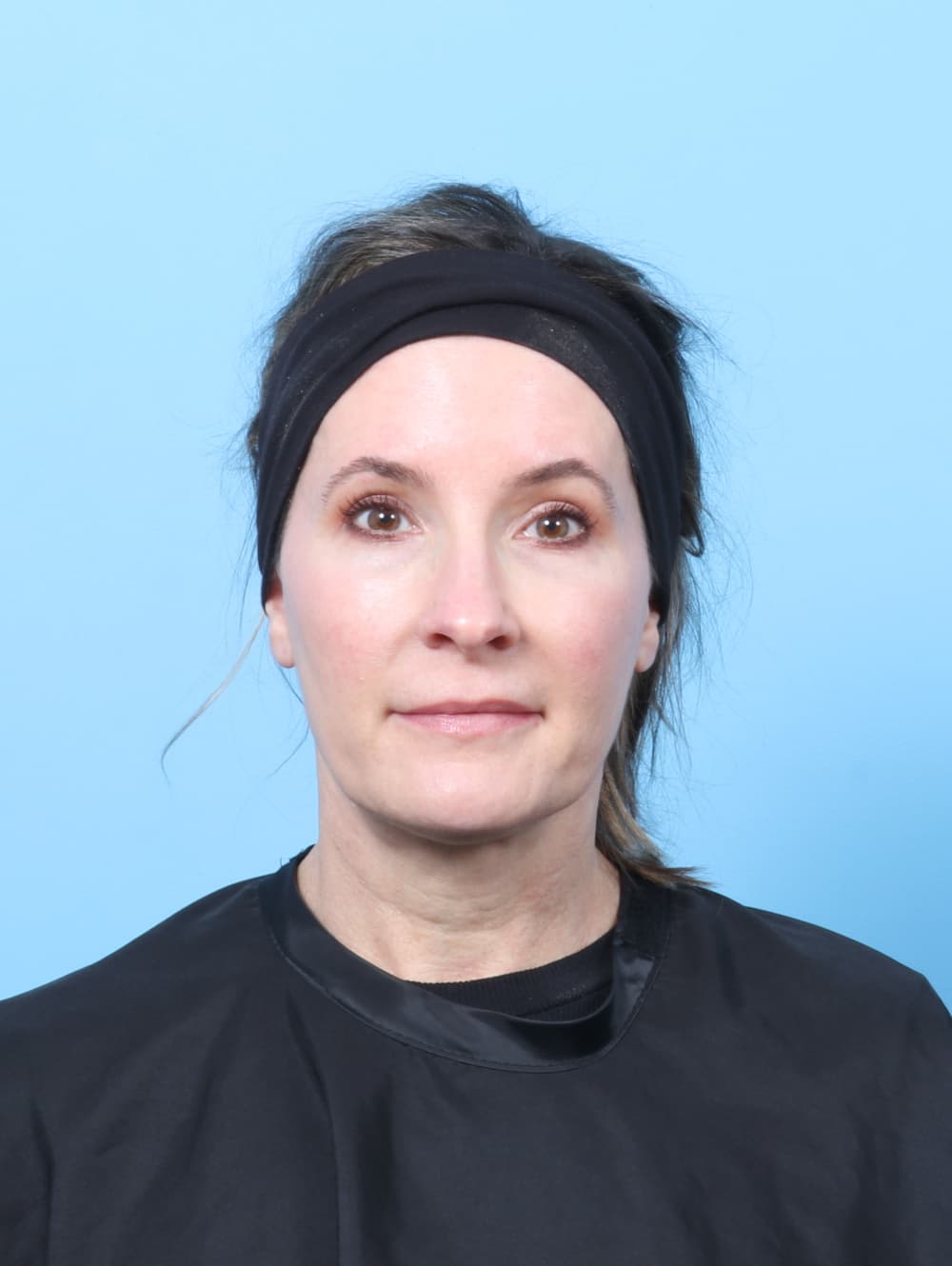 Eyelid Surgery case #8792 after