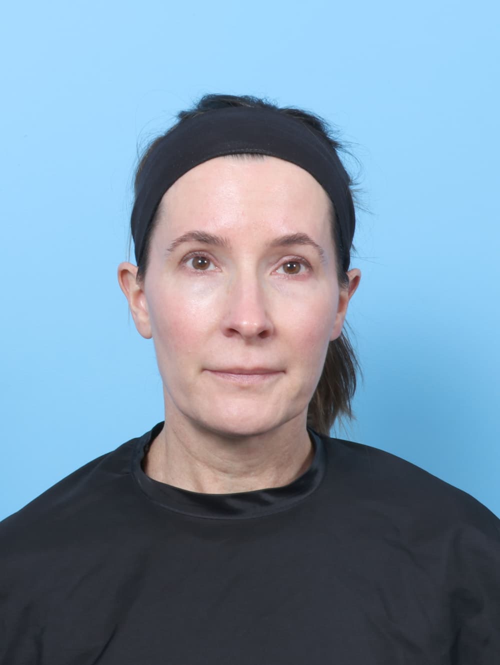 Eyelid Surgery case #8792 before