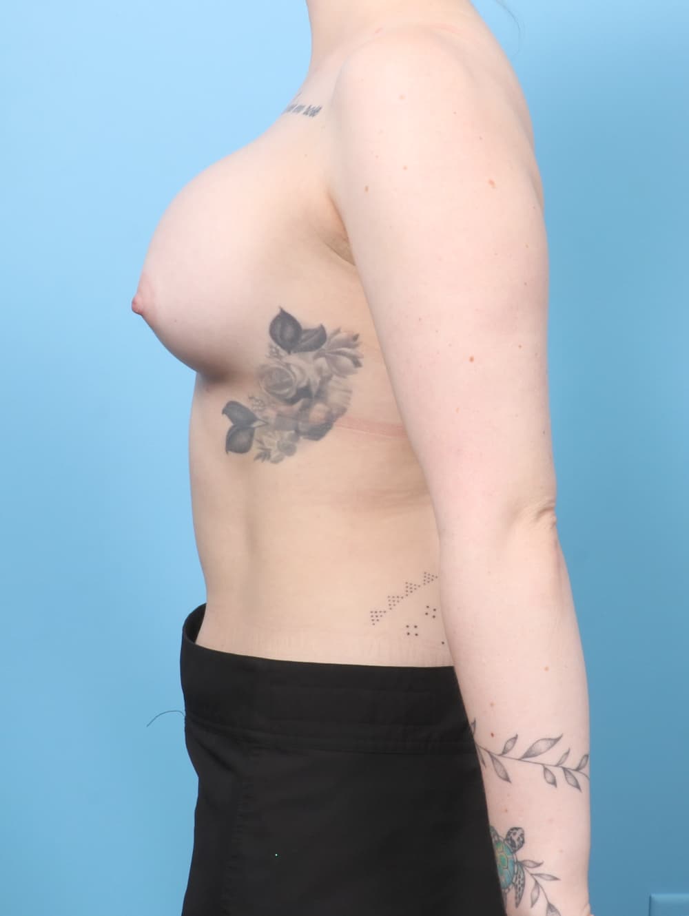 Breast Augmentation case #8409 after, image 3