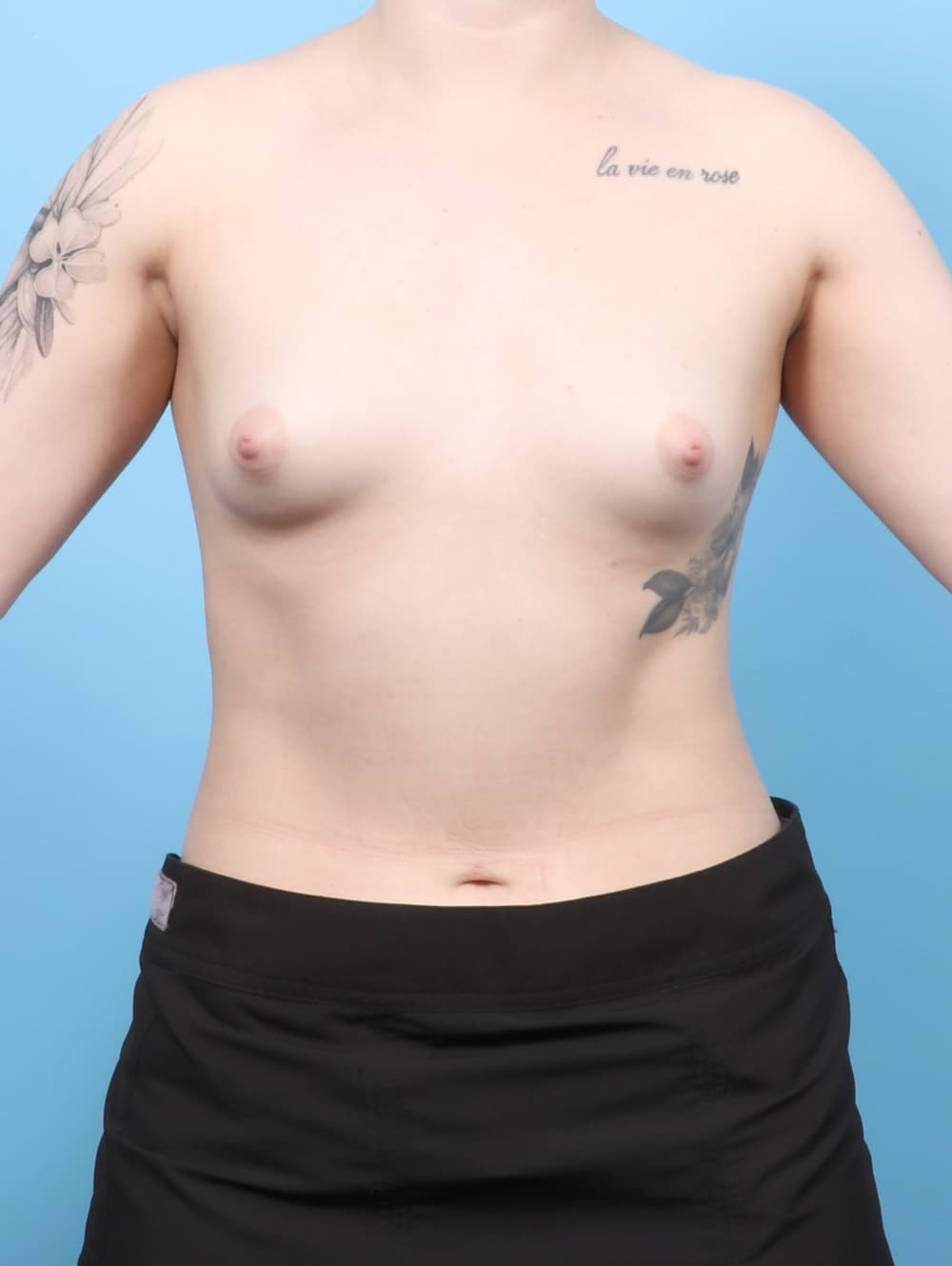 Breast Augmentation case #8409 before, image 1