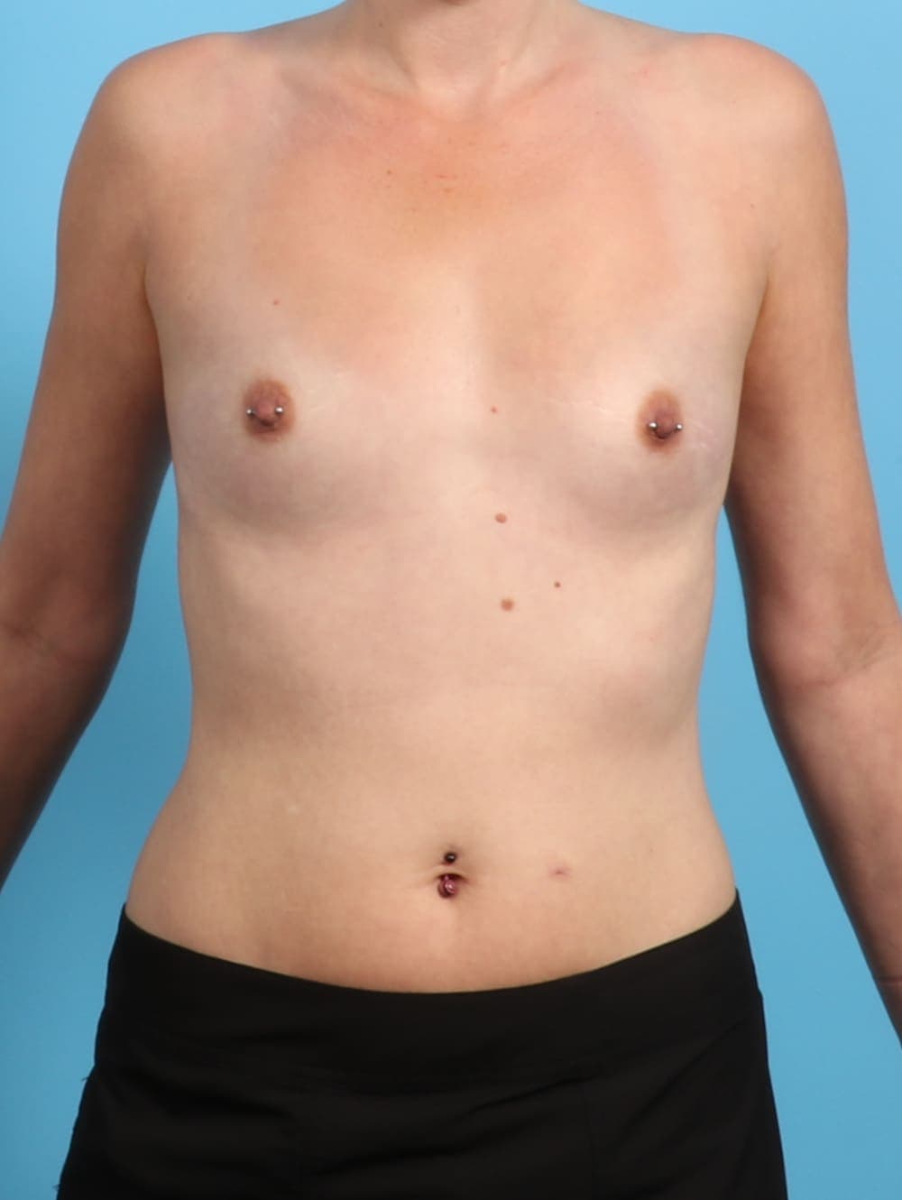 Breast Augmentation case #2905 before, image 1