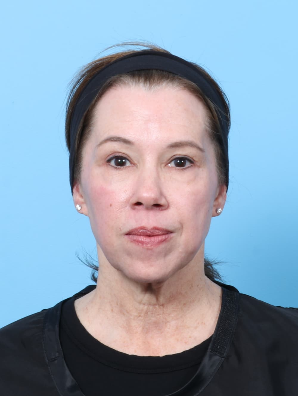 Eyelid Surgery case #8463 after