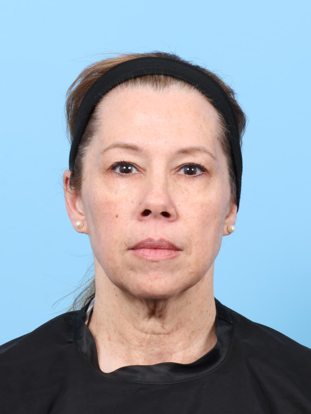 Eyelid Surgery case #8463 before