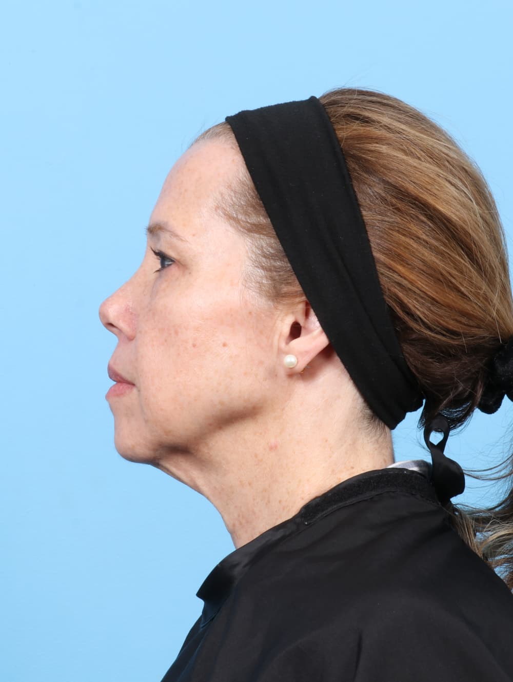 Eyelid Surgery case #8463 before, image 3