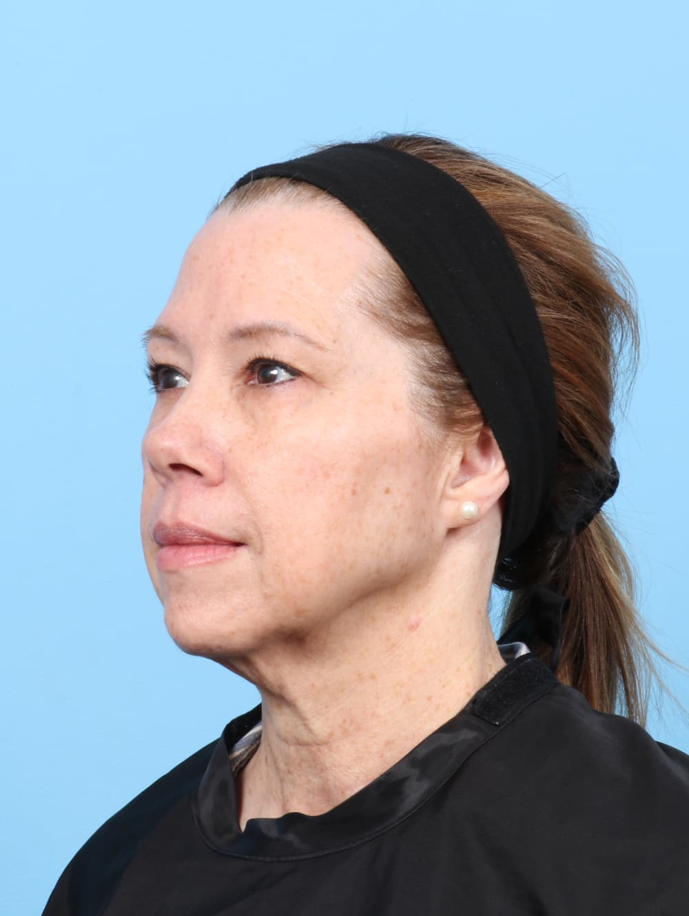 Eyelid Surgery case #8463 before, image 2