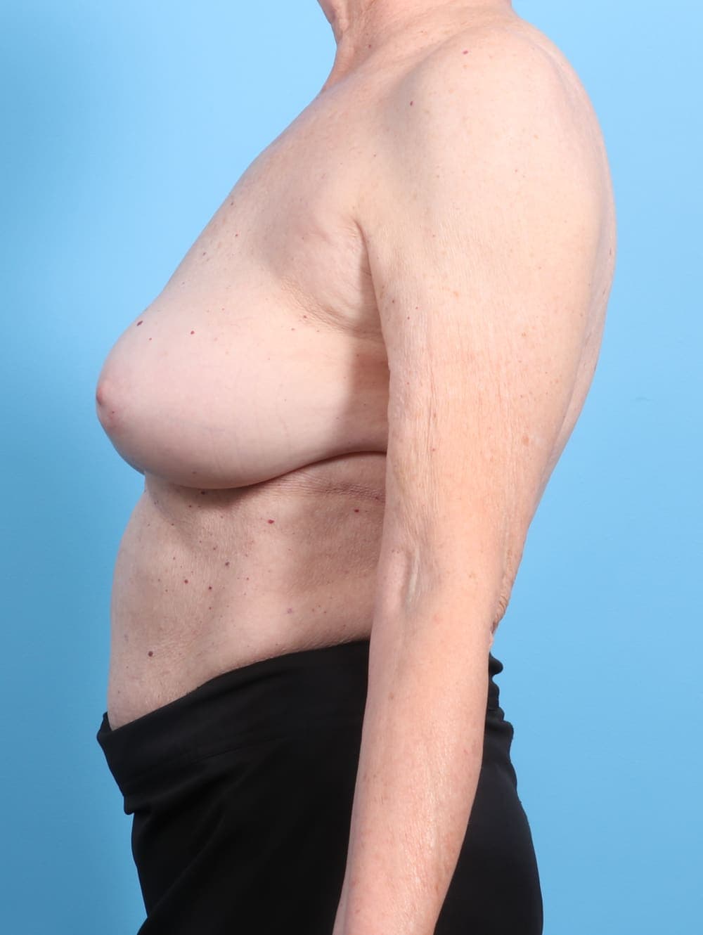 Breast Implant Revision case #2346 after, image 3