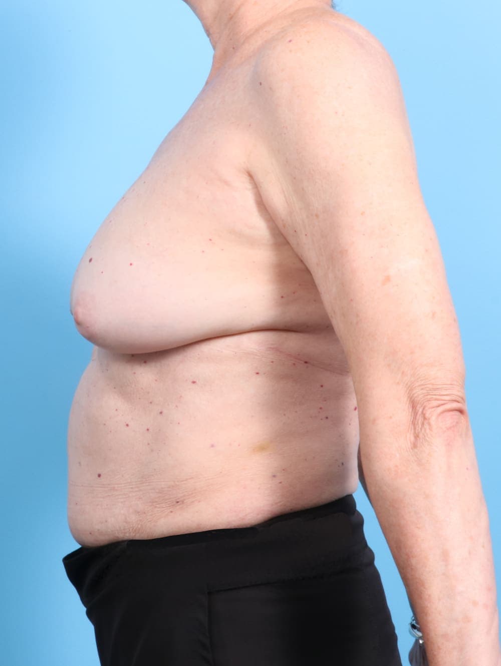 Breast Implant Revision case #2346 before, image 3