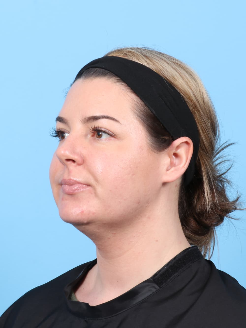 Facial Liposuction case #8195 before, image 2