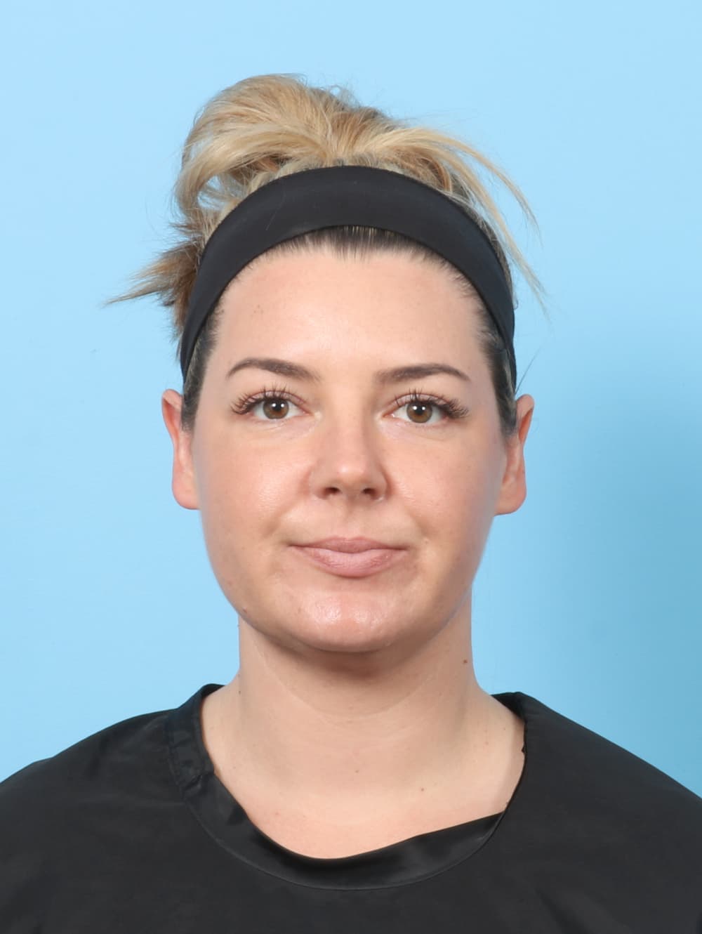 Facial Liposuction case #8195 after, image 1