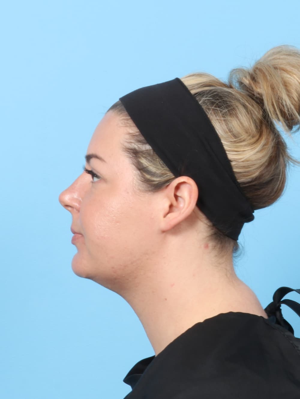Facial Liposuction case #8195 after, image 3
