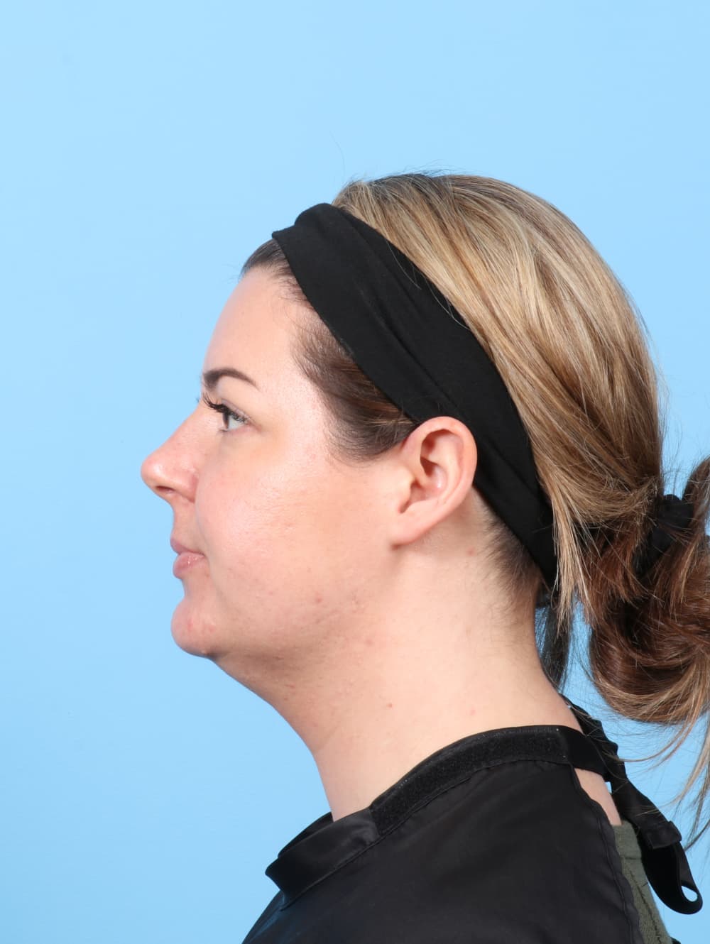 Facial Liposuction case #8195 before, image 3