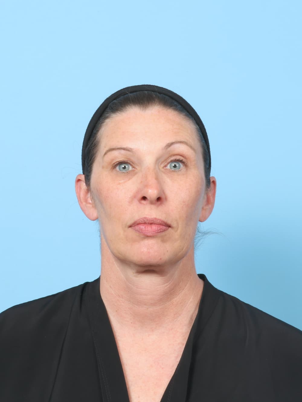 Eyelid Surgery case #8716 before, image 1