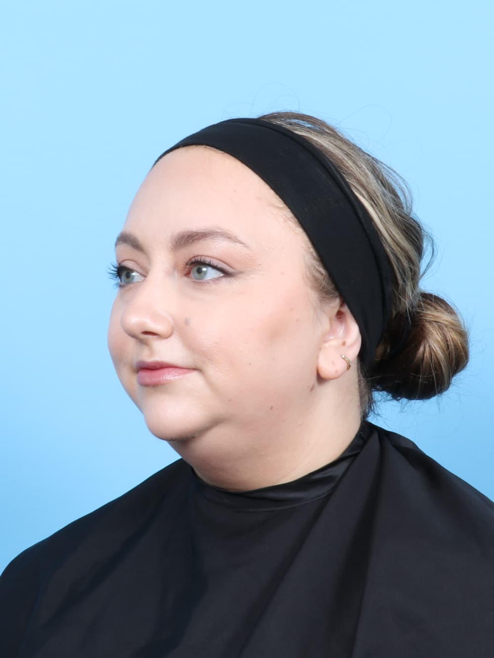 Facial Liposuction case #7686 before, image 2