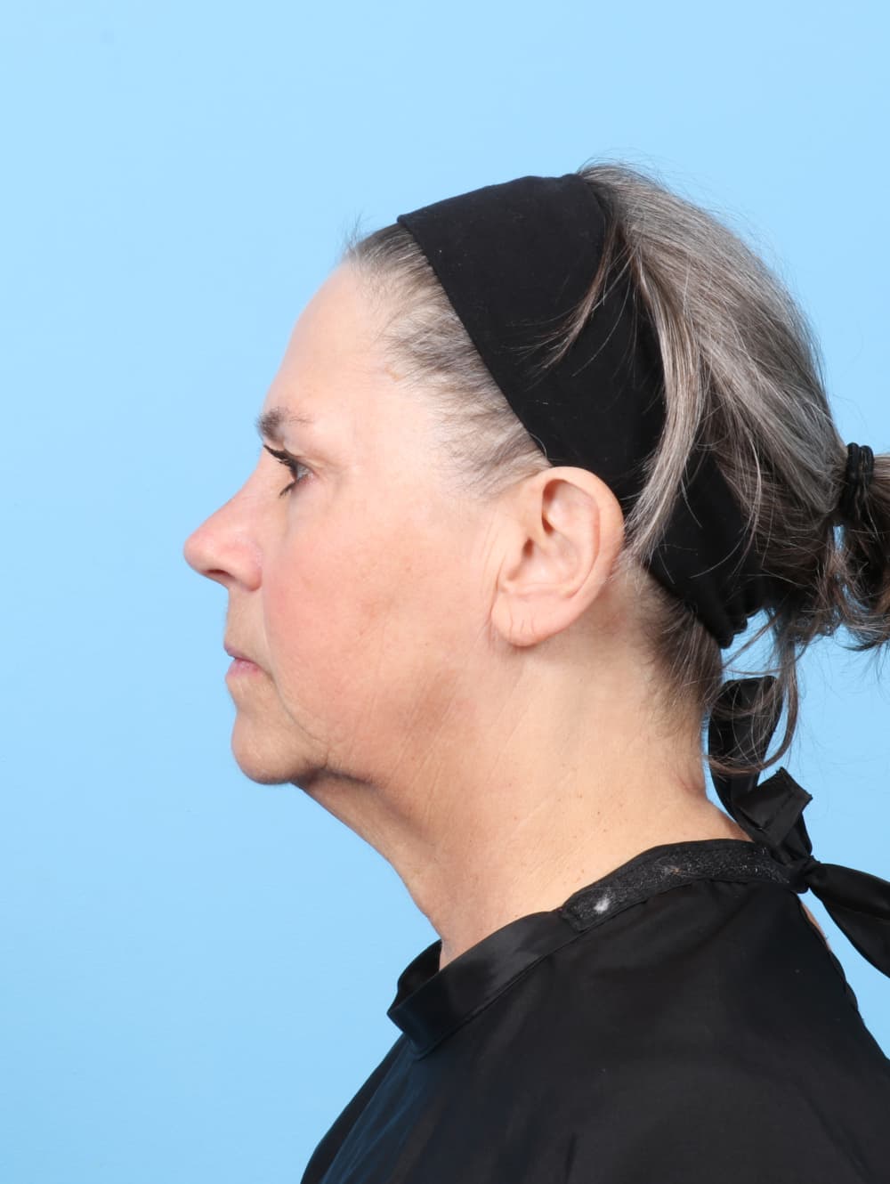 Facelift case #8394 before, image 3