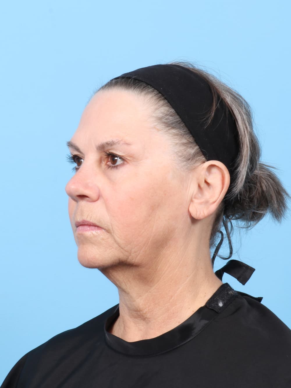 Facelift case #8394 before, image 4