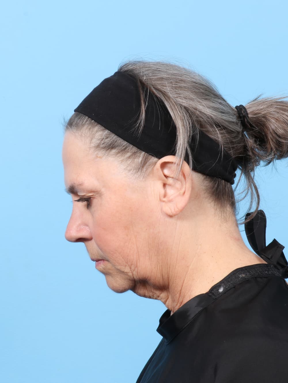 Facelift case #8394 before, image 2