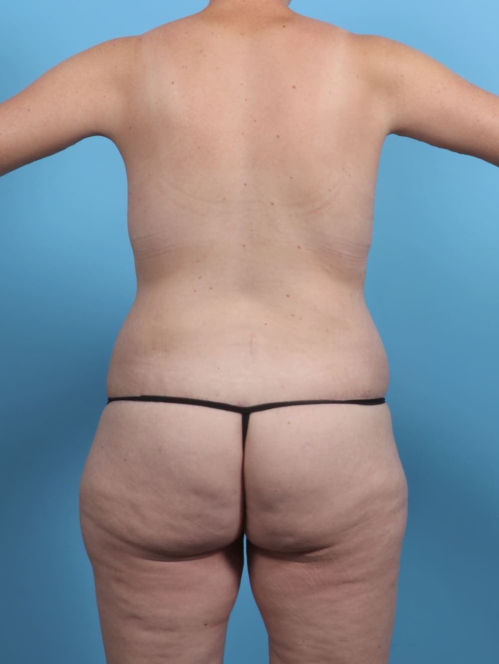 Body Lift case #3827 after, image 4